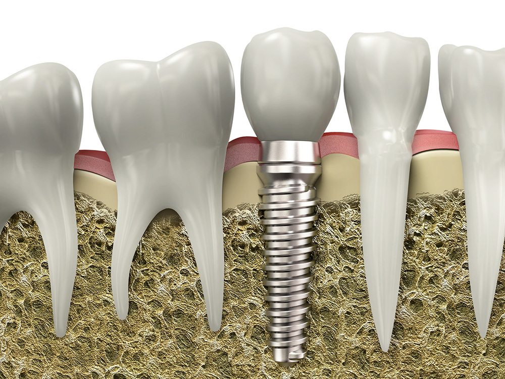 Dental Implants in West Kelowna