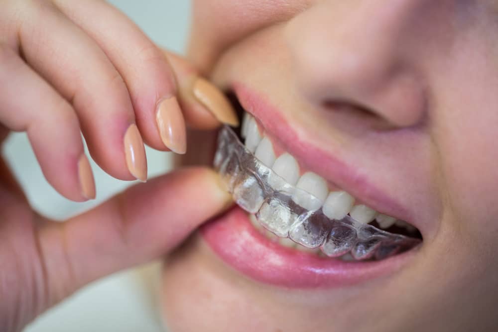 5 Questions to Ask at Your Orthodontic Consultation