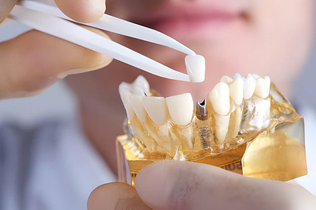 How Long Do Implants Take To Heal?