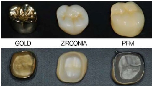Understanding Dental Crown Materials From Porcelain To Zirconia