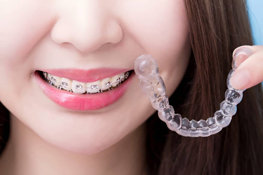 What Are The Most Discreet Orthodontic Options for Adults?